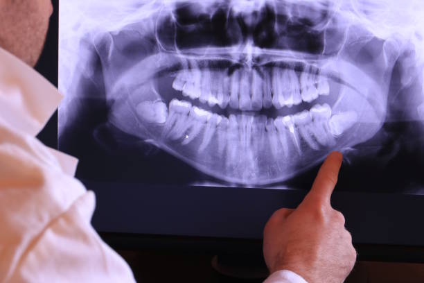 Best Emergency Wisdom Tooth Extraction in Thunderbolt, GA