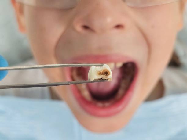 Best Broken or Chipped Tooth Repair in Thunderbolt, GA
